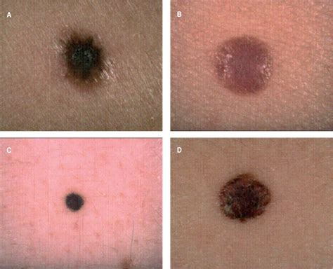 colorless nodular melanoma pictures